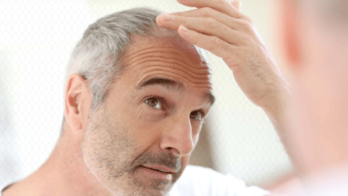 6 عوامل سبب تساقط الشعر بكثرة عند الرجال، تعرف عليها