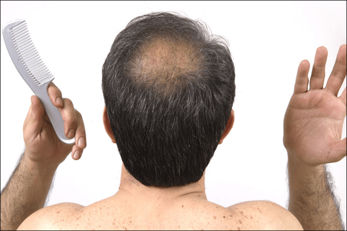 hair loss causes 2022 gegr 33 - 6 عوامل سبب تساقط الشعر بكثرة عند الرجال، تعرف عليها
