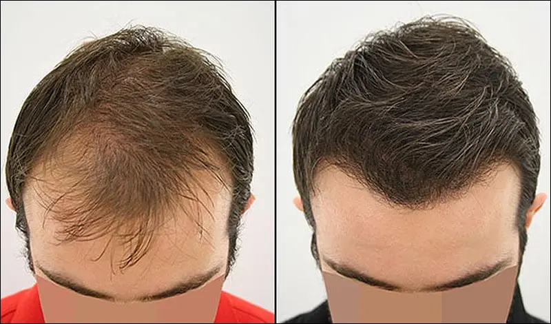 نتائج عملية زراعة الشعر