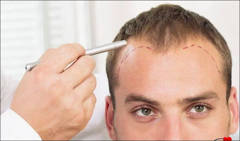 تخطيط الجبهة لزراعة الشعر