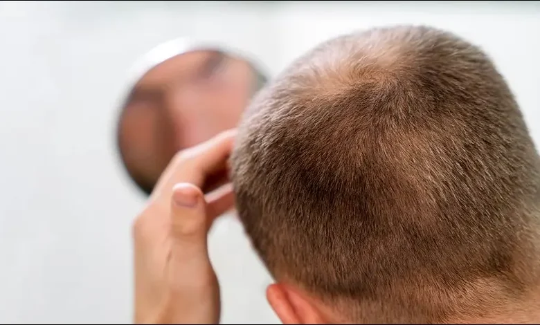 خطوات زراعة شعر الرجال (12 نصيحة بعد زراعة بصيلات الشعر)